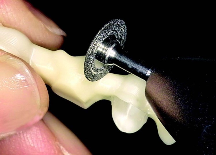 Separator diamentowy TURBO C8-FG, na turbinę protetyczną (zdjęcie pracy).jpg