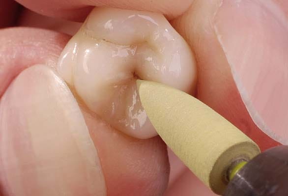 CeraGlaze P30044 gumka do cyrkonu i porcelany zdj. pracy.jpg