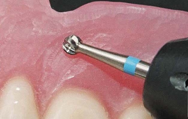 Frez protetyczny HF071CE kulka do akrylu i metalu (zdjęcie pracy).webp