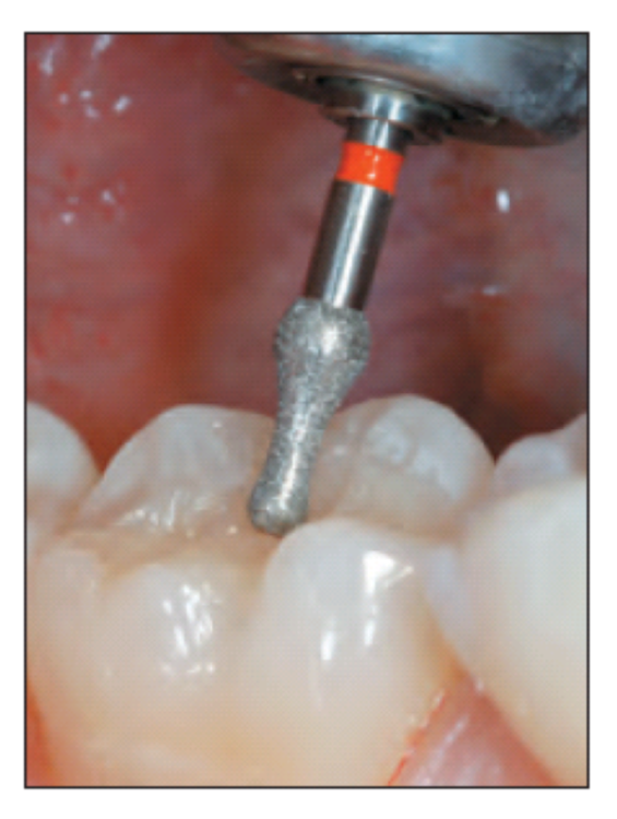 Wiertło diamentowe 370 specjalny pączek (zdjęcie pracy).png