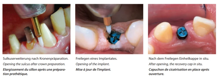 Wiertło ceramiczne Tissue Trimmer (etapy pracy).png