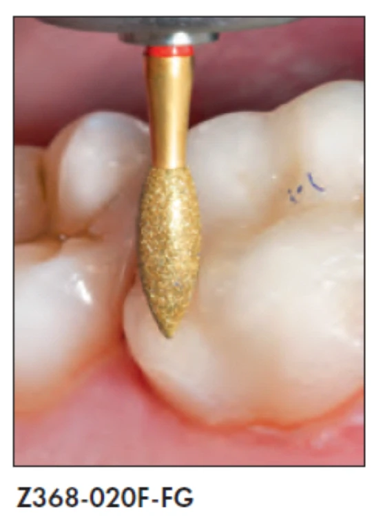 Wiertło diamentowe ABACUS Z368 płomyk-jajko (zdjęcie pracy).png