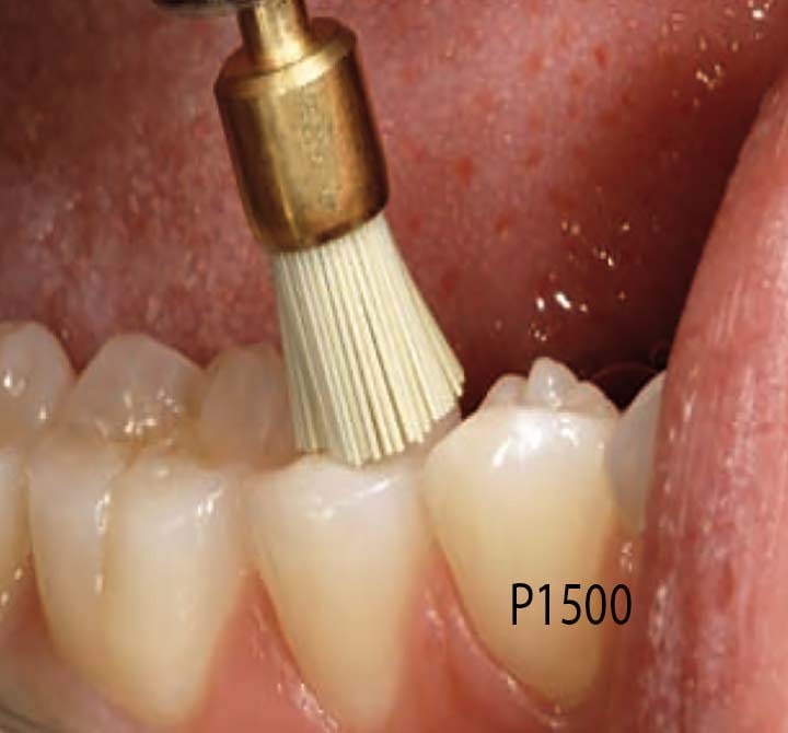 Szczoteczka krzemowa P1500 wąski kielich - zdjęcie pracy.jpg