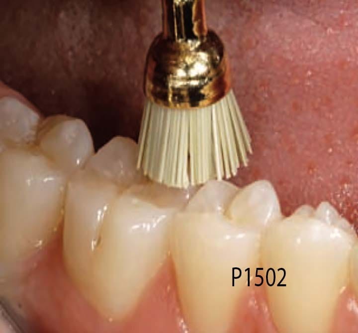 Szczoteczka krzemowa P1502 szeroki kielich - zdjęcie pracy.jpg